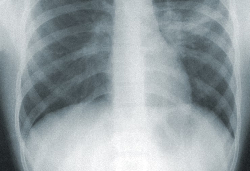Radiographic scan of human